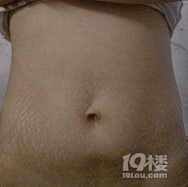 产后妊娠纹,辣眼睛(有图慎入)-准妈妈俱乐部-准