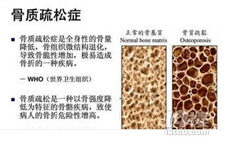 骨質(zhì)疏松的9大謠言,你被忽悠了嗎?