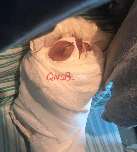 杭州一大姐倒了一趟垃圾,四根脚趾断了.