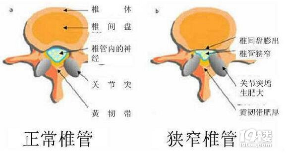 腰突症与五大常见腰病-交流讨论-养生保健-杭州