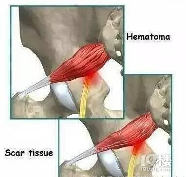 久坐腰不疼,腿麻屁股疼?