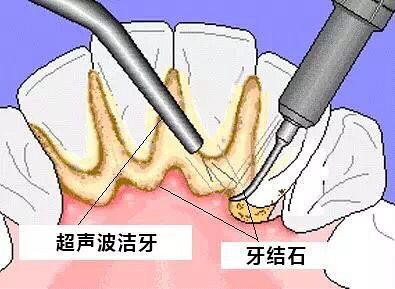 洗牙有没有必要,看完后你就能解开多年来的疑