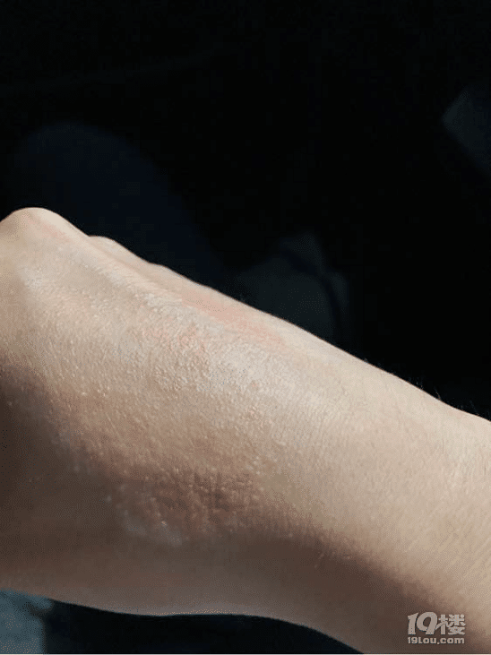 手上突然就开始长湿疹了是什么情况啊
