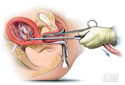 什么是人流 人流最佳时间是什么时候