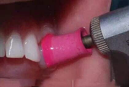 小朋友牙齿上的黑色素能去掉吗?_杭州绿城口