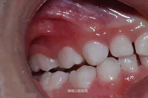 小朋友牙齿上的黑色素能去掉吗?_杭州绿城口