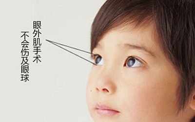 艾格眼科小儿微创无痕斜视纠正术 改斜归正,