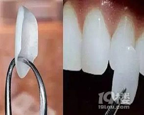 Baby小虎牙消失,原来整牙可以这么美!