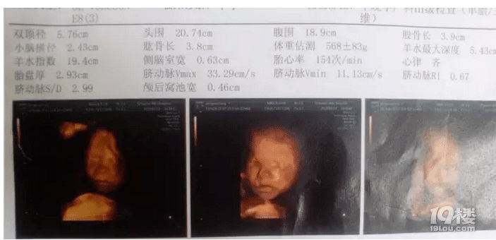 B超單上的羊水指數(shù)是什么?多少算正常?