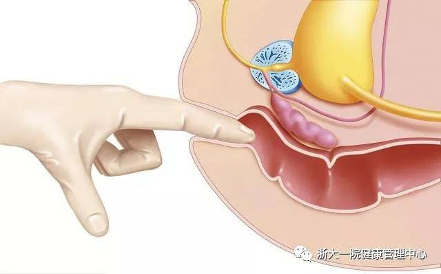 浙一医院:直肠指检,您拒检了吗?_军缘健康管理__杭州19楼