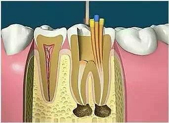 牙齿需要治疗是什么意思?根管治疗最强图解!_