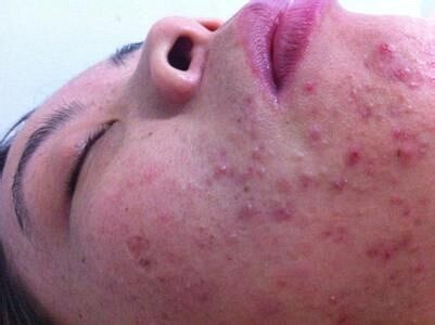 脸反复过敏,红,痒,小疹子,痘痘,多数是面部激素