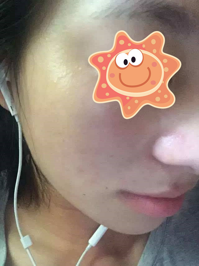 怎样去疤痕最好 2018与美丽说Hello