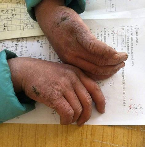 今天这个冰花男孩火了看着他的双手你还有什么可抱怨的