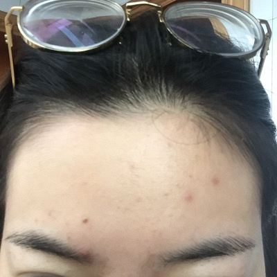 祛疤药膏有什么牌子好 祛疤产品排行榜10强