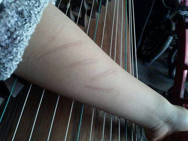 开水烫伤怎么去疤痕 去烫伤疤痕最快的方法