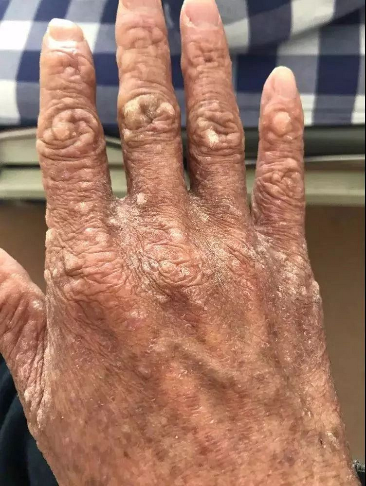 事 帖子不少人都吃过牛黄解毒片吧 牙龈肿痛来几片 口舌生疮来几片