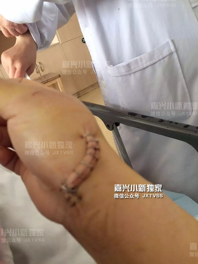 爆断手筋嘉兴妇女洗澡受伤这个浴室用品太危