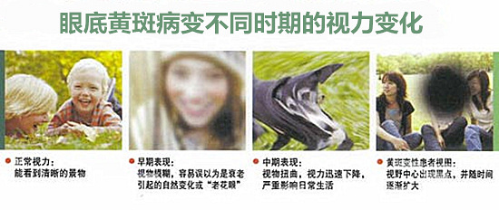 武汉黄斑病变如何治疗,艾格眼科专家说PDT光