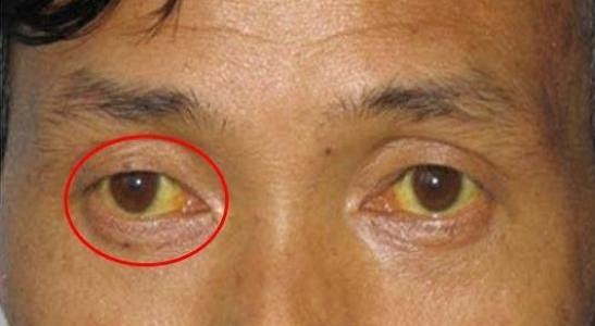 这3种眼睛被称作肝炎眼,常吃硒麦芽五味子片清