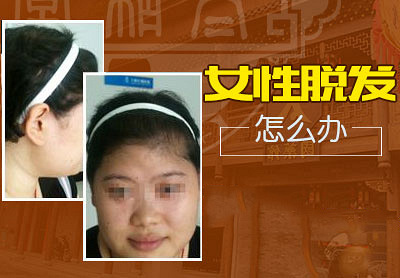 杭州太和堂脱发治疗中心【脱发专科】年轻女性