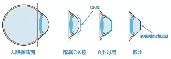 关于近视、白内障、青光眼等,眼科医生终于道