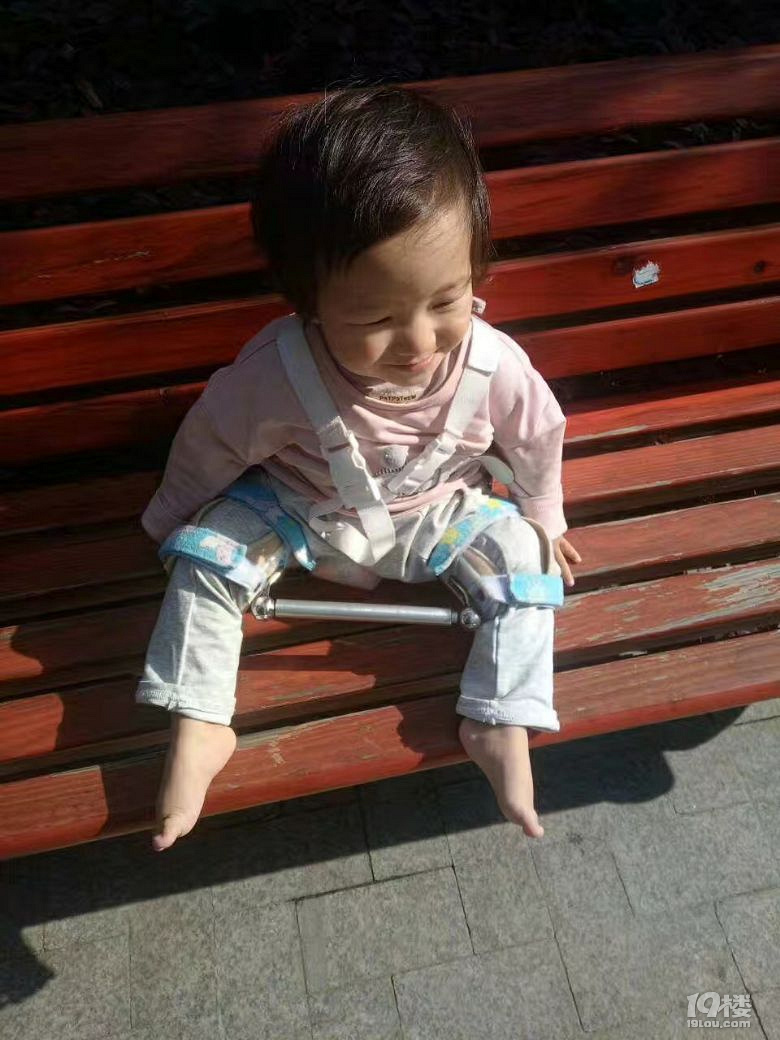 【宝宝生病记】小儿髋关节脱位冶疗历程