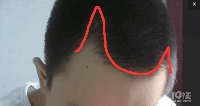 本人親自踩坑�。�!杭州**醫(yī)療植發(fā)簡(jiǎn)直是垃圾!已遞律師函