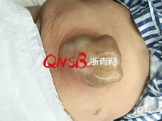 杭州大妈肚脐眼上长了个洞一直不愿手术结果肠子差点流出来
