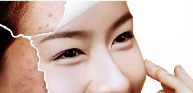 西安画美医疗美容医院-怎么控油去痘印