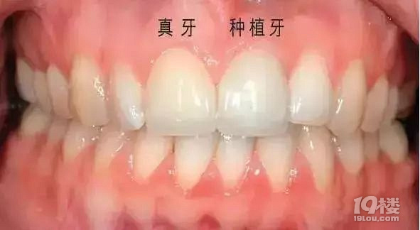 杭州西傲口腔:说种牙很疼的人,其实是没有做过