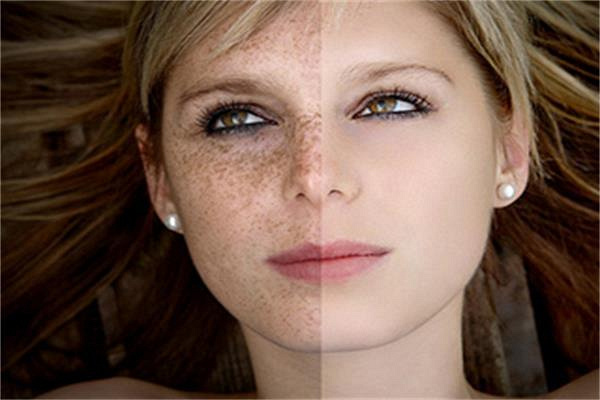 脸上长色斑了?你还不打算祛斑吗