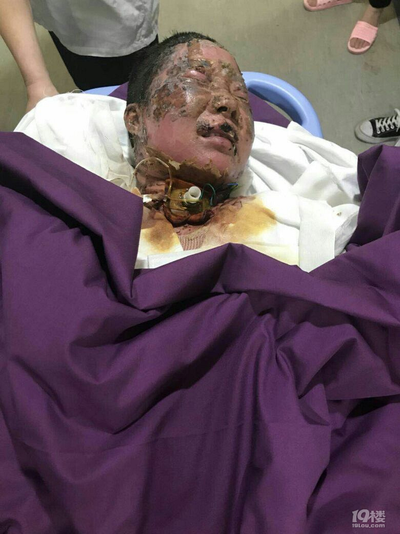 心疼一家三口在外打工遇煤气爆炸3人烧成重伤没钱治疗