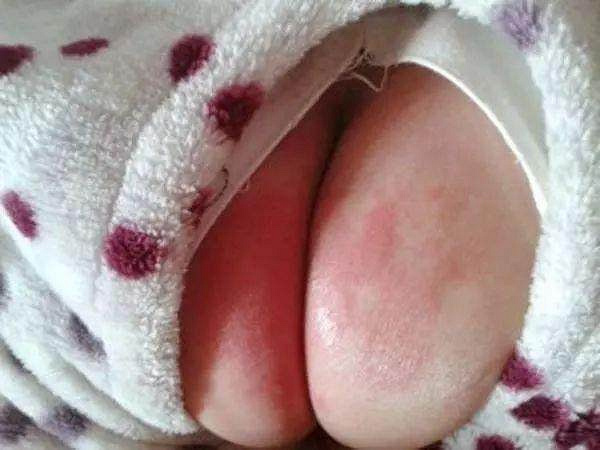 宝宝红屁屁, 育儿专家不建议做的3件事, 大半妈