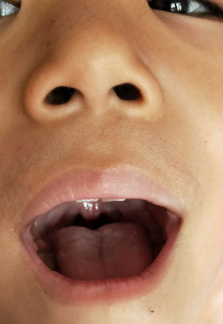 扁桃体二度三度肿大如何治愈