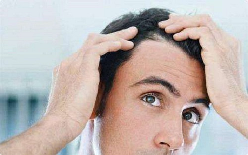 得了脂溢性脱发头发油腻腻的怎么办呢?