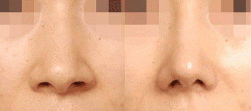 西安画美医疗美容医院——缩鼻头有那些方法?