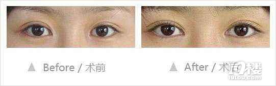 你真的需要开眼角吗？