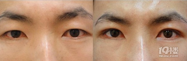 你真的需要开眼角吗？