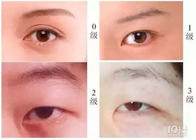 你真的需要开眼角吗？