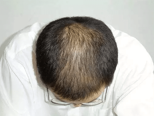 植发后毛囊成活率是多少?广州科发源发际线移