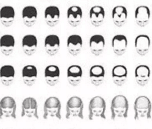 植发后毛囊成活率是多少?广州科发源发际线移