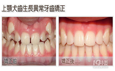 整牙可以把虎牙拔掉吗?