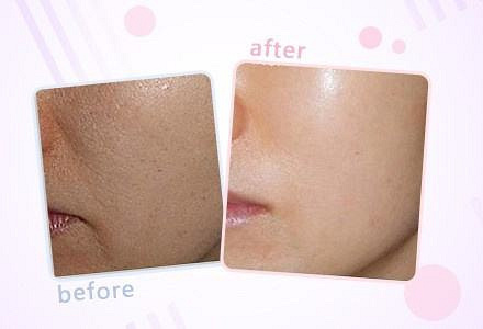 西安画美医疗美容医院-怎样提亮肤色改善暗沉