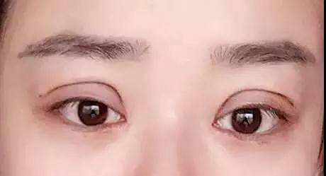 割双眼皮有那些误区?