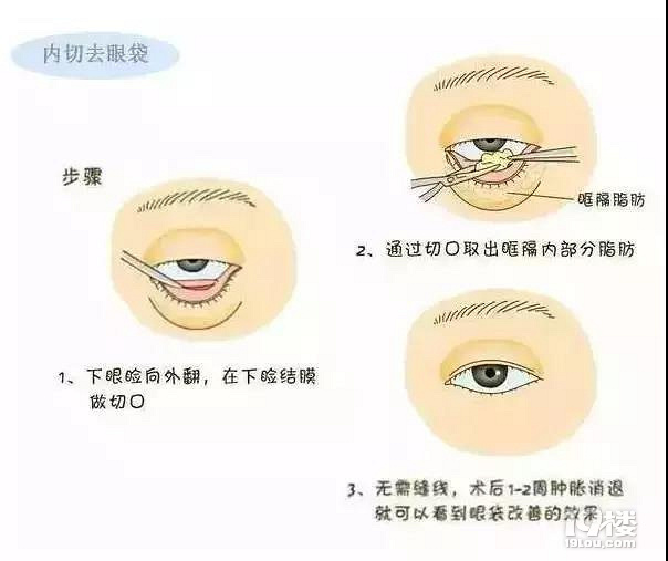 眼袋有多深,你就有多老!