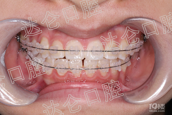 口腔医院 患者官宣:复杂牙齿矫正达仑口腔有办法