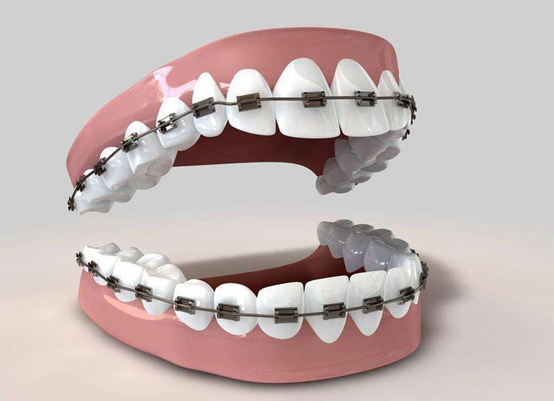 西安画美医疗美容医院-上完牙套后要怎样清洁