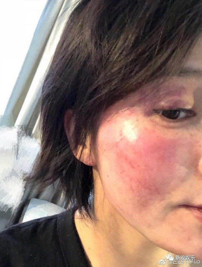 今天贴了一张王雨馨脸部受伤的照片