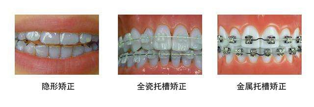 西安画美医疗美容医院-牙齿矫正方法是针对不